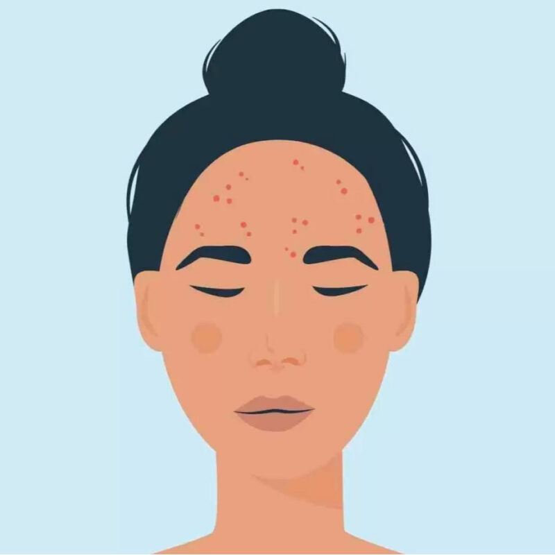 Pourquoi l’acné à 40 ans
